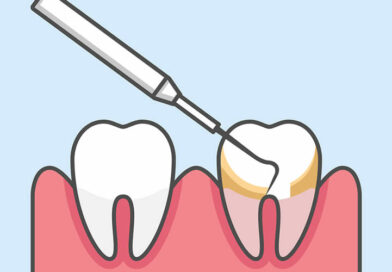 Diş Taşı Hassasiyet Yapar mı?