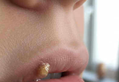 Uçuk Neden Olur? Uçuğa Katran Sürülür mü?